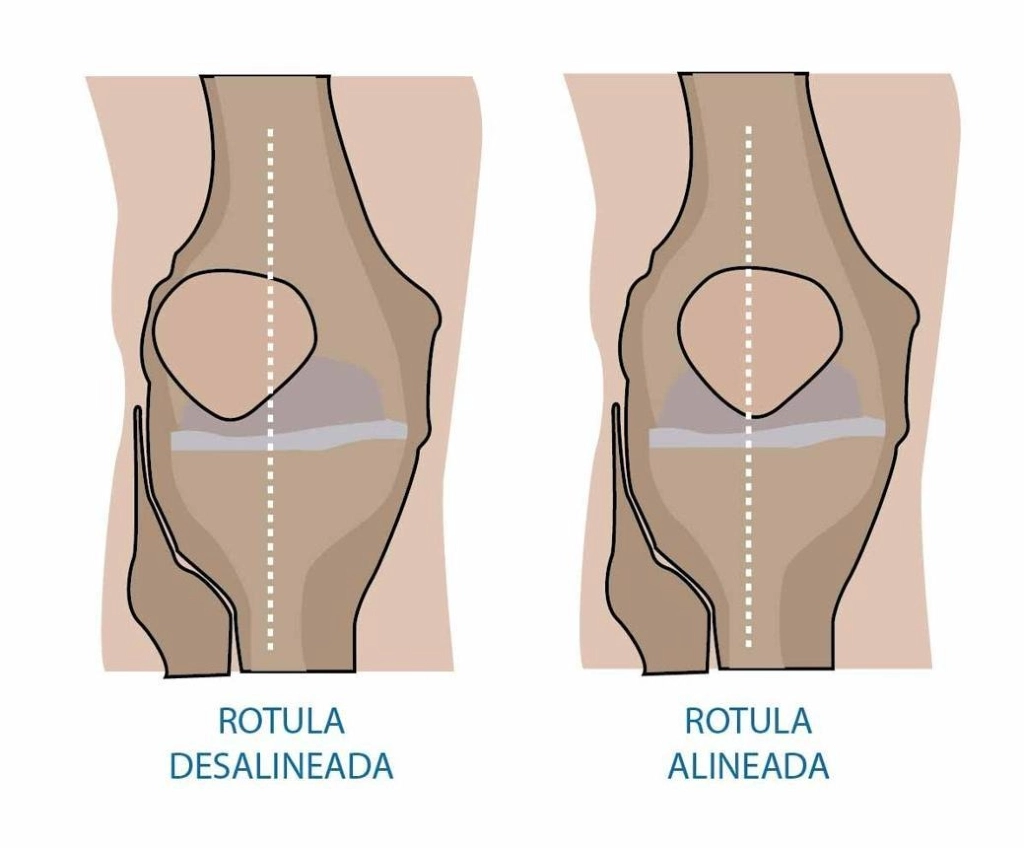 mala alineacion rotula