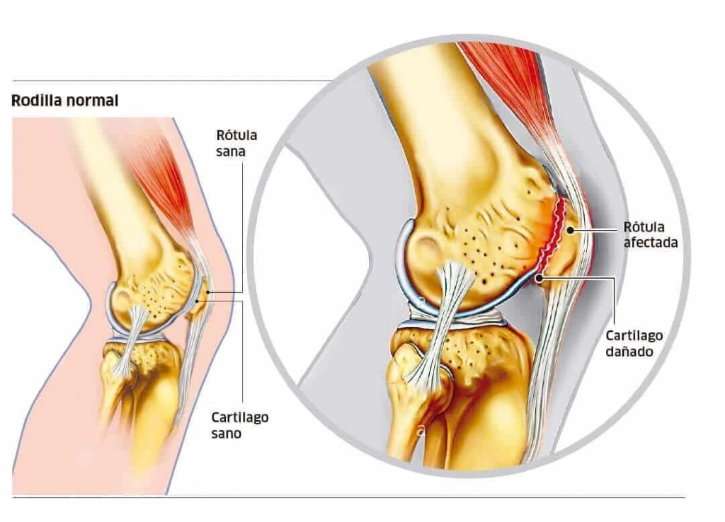 Relación entre la condromalacia rotuliana y la escoliosis