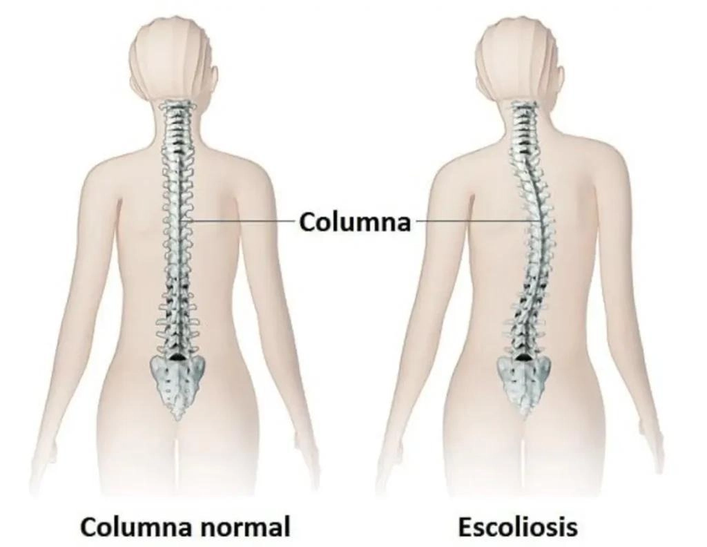 relación escoliosis juvenil y edema óseo