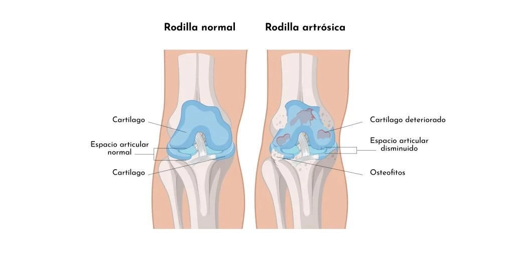 edema oseo y escoliosis juvenil