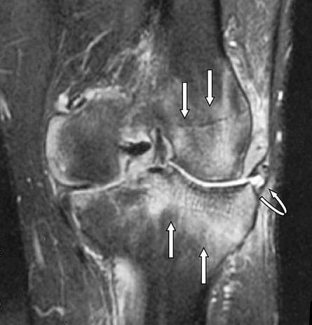 edema oseo en la rodilla