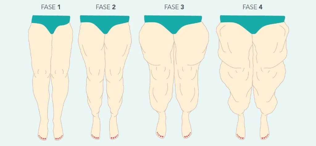 fases del lipedema