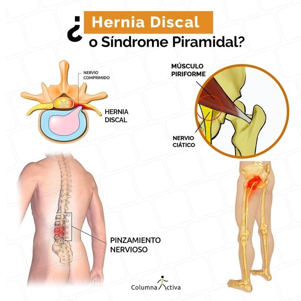 diferencias entre la ciatica y el sindrome piramidal