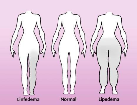 como identificar el lipedema
