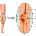 Edema óseo en la rodilla: causas, relación con escoliosis juvenil y tratamiento en Córdoba