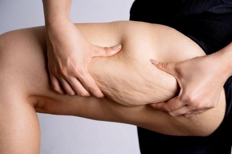 Fisioterapia en lipedema: tratamiento, complicaciones y recuperación postquirúrgica