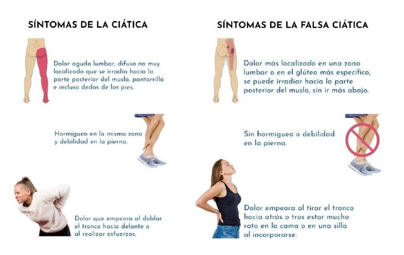 sintomas de la ciatica y el sindrome piramidal